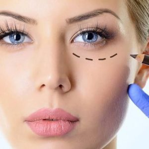 blefaroplastia